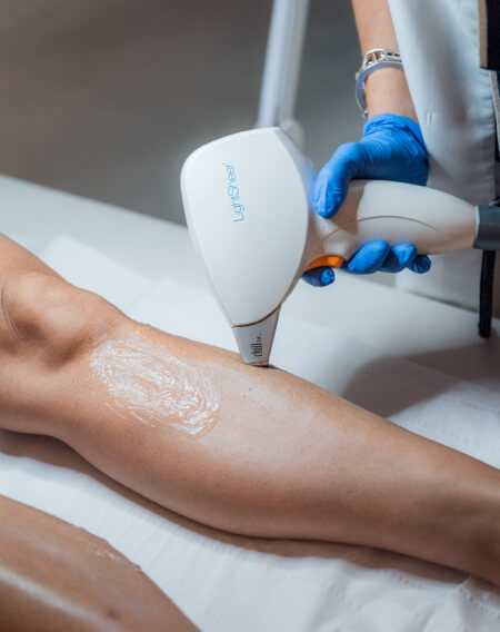Séance d'épilation laser LightSheer sur jambe